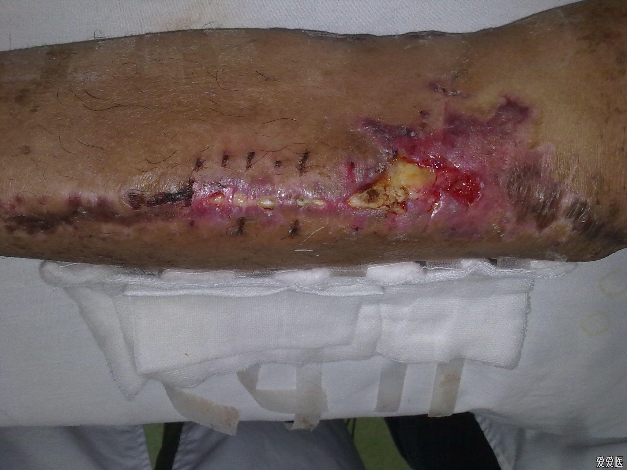 左胫骨骨拆术后半年骨外露,如何处理