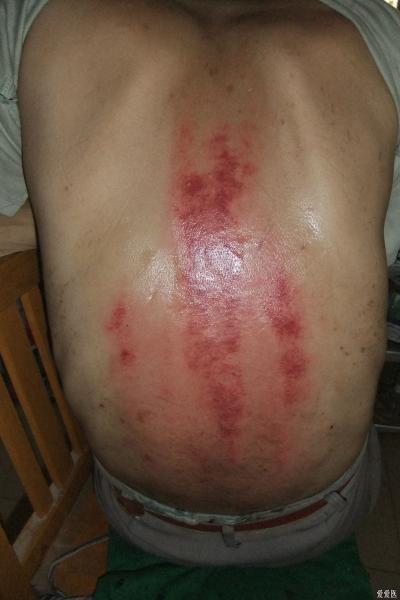一例腰疼病人刮痧后的反应