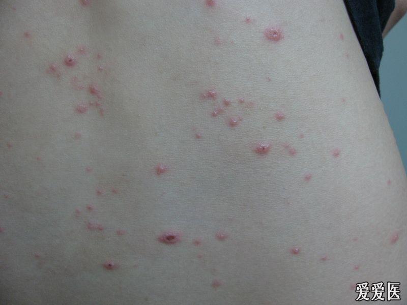 水痘疫苗后皮疹图片图片