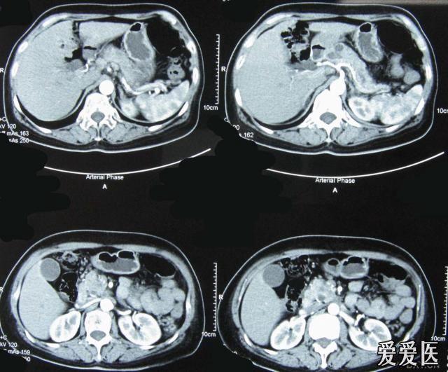 ipmt(胰腺导管内乳头状肿瘤)一例