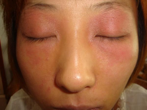 眼周皮肤化妆品皮炎的治疗前后