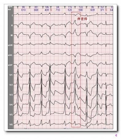 山羊老师课程常见心电图基础知识讲座第九讲——有关q波知识