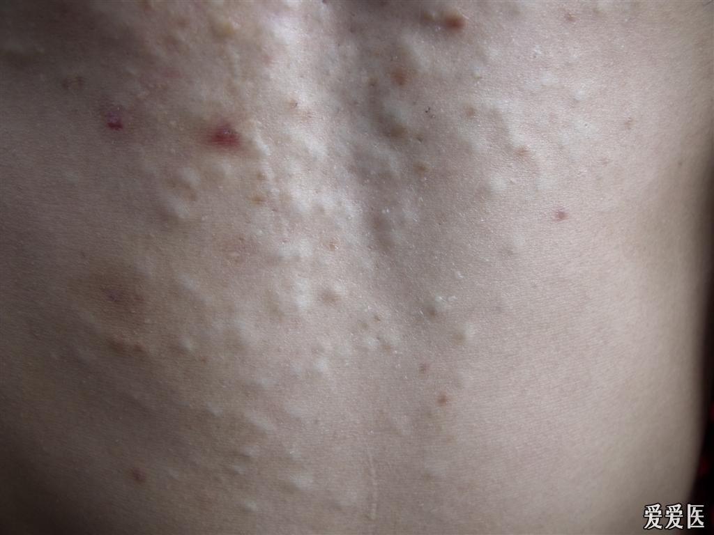 岁  皮肤病变一年  只有胸部  其他地方没有 ,皮下遍及黄豆大小的囊肿