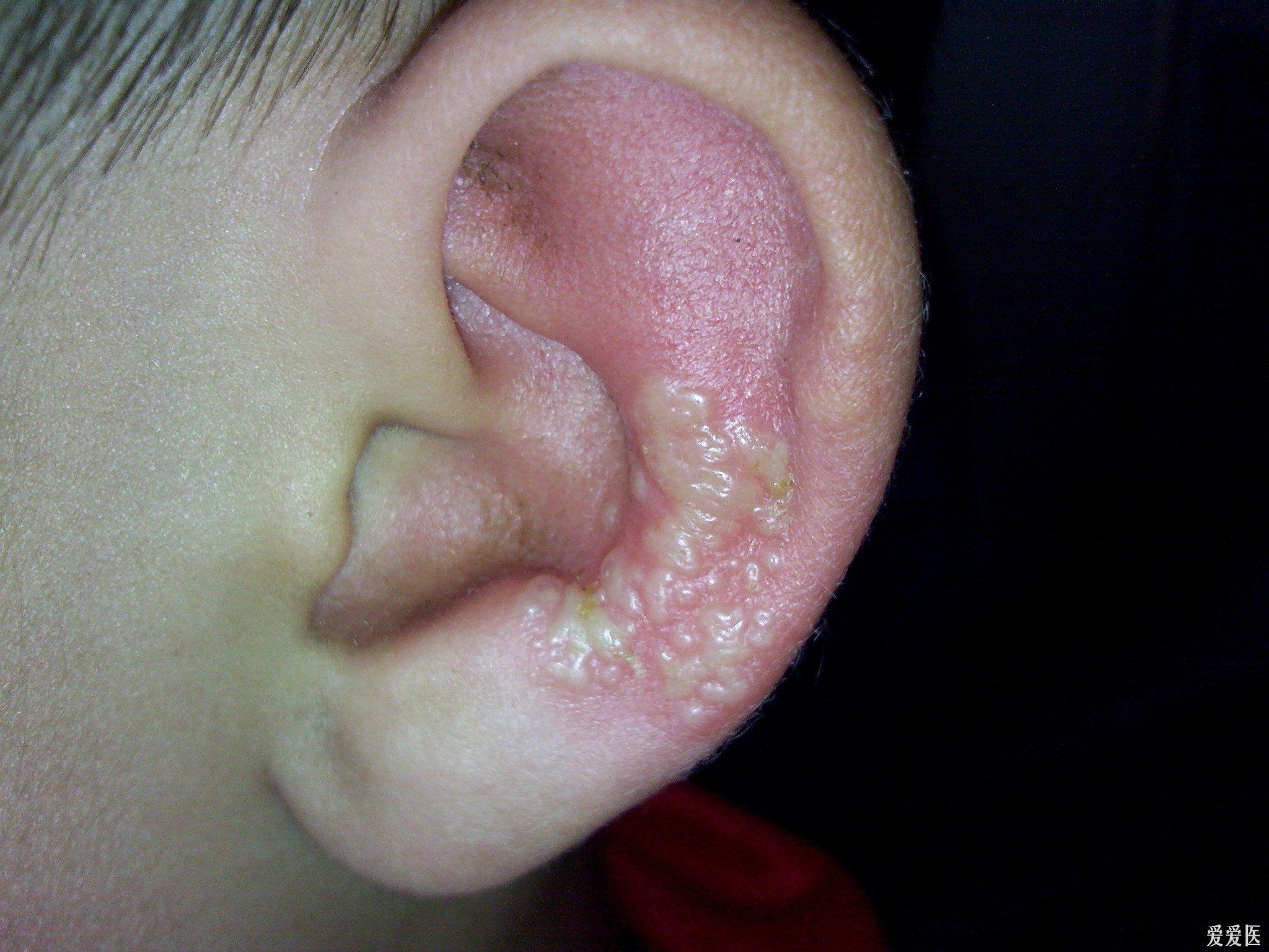 宝宝耳部湿疹的图片图片