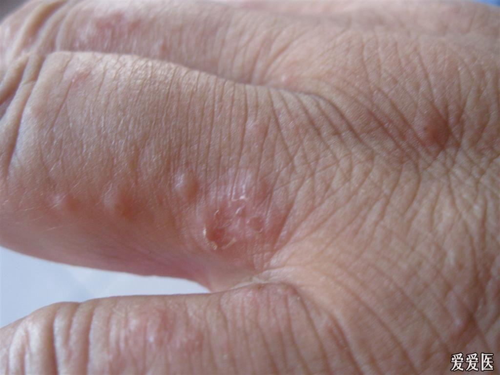 治疗三天后疥疮症状消失.