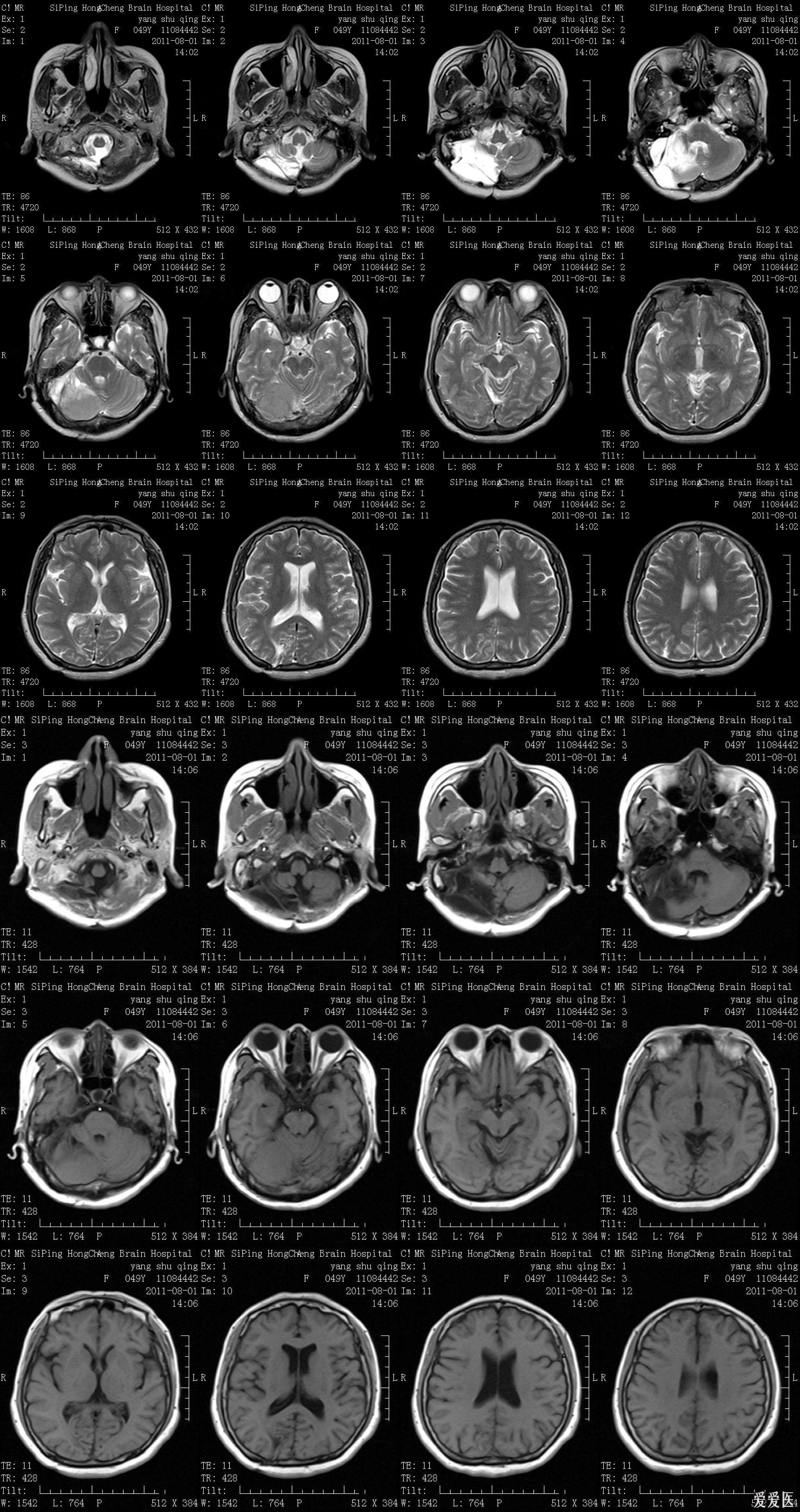 小脑核磁共振图片图片