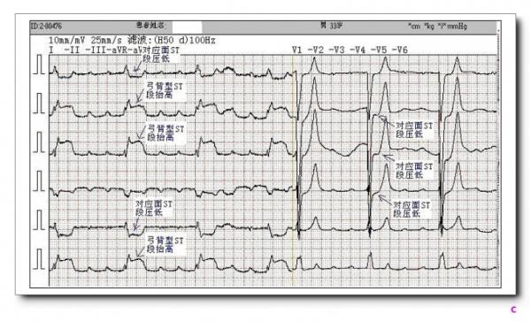 t波高耸v2v4图片