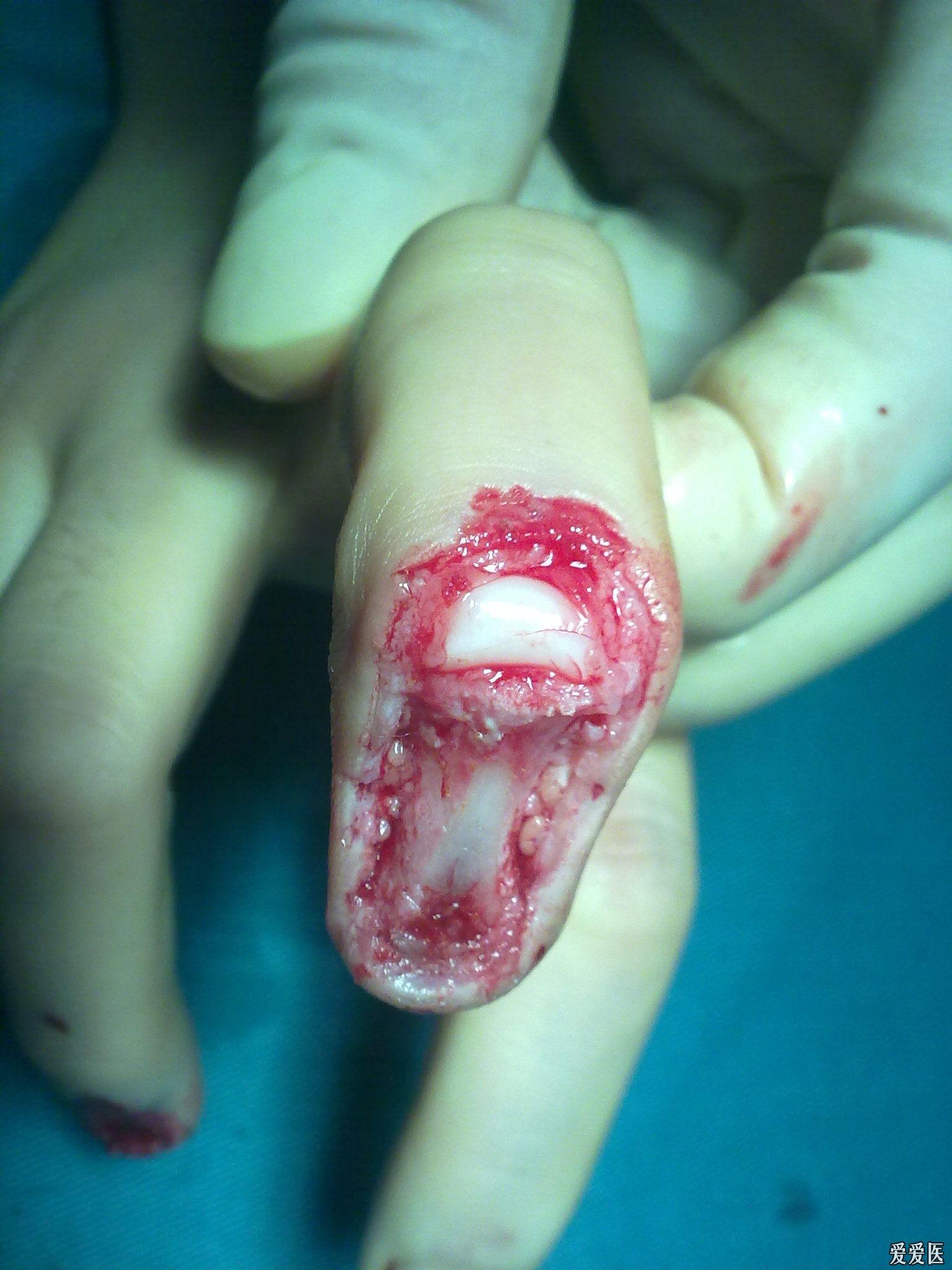 手指皮瓣手术后期整容图片