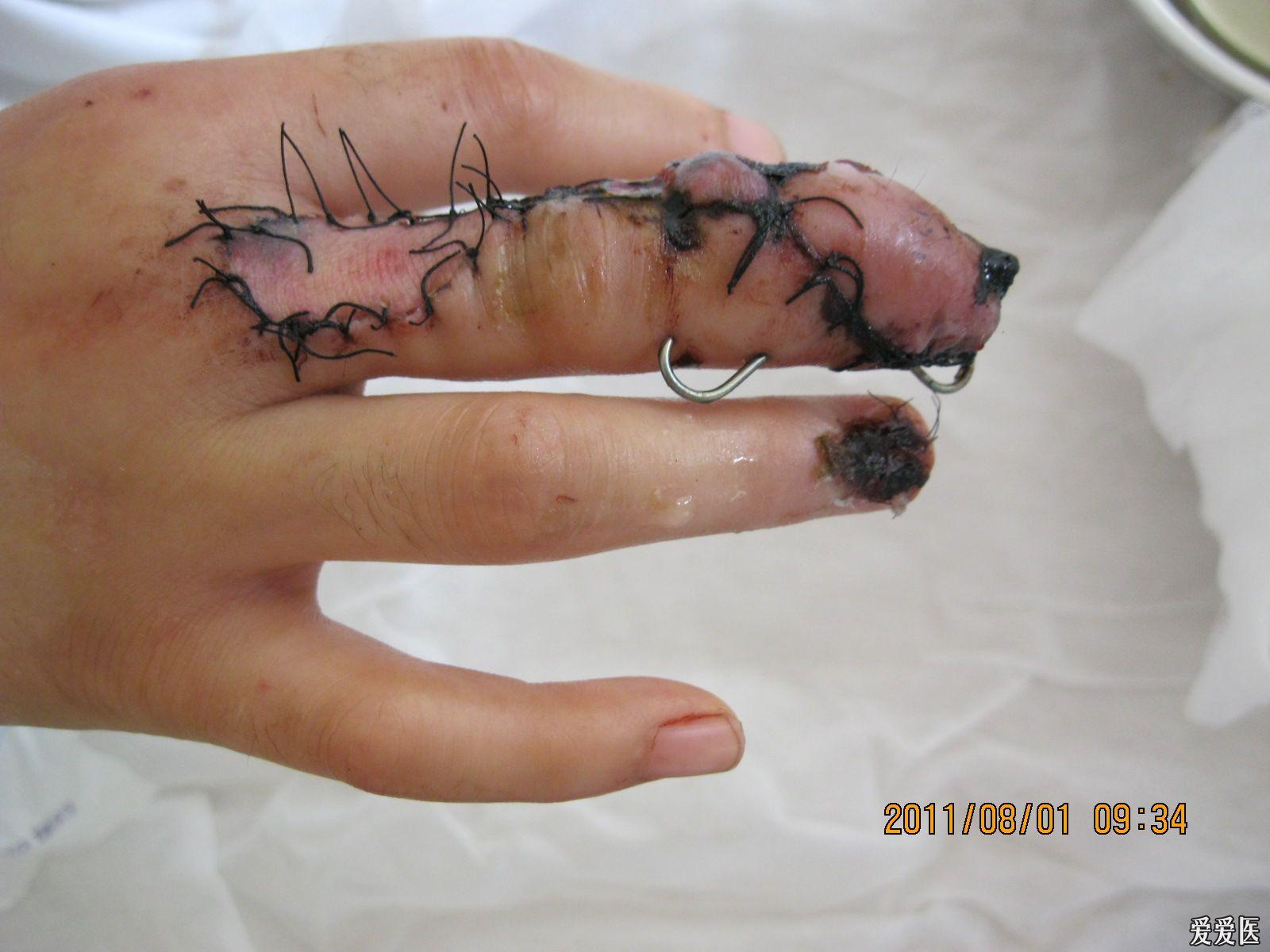 中指腱鞘炎手术图片图片