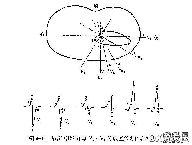 qrs 波的问题 