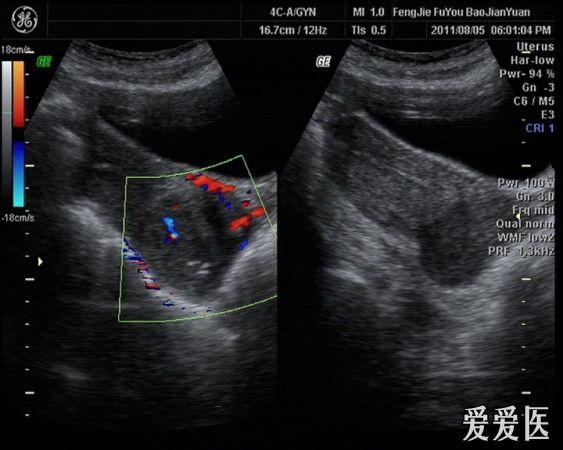 子宮頸ca可能性大