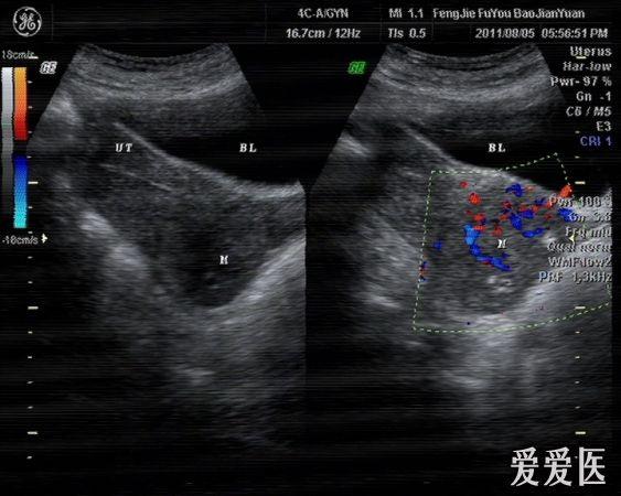 子宫颈ca可能性大 超声医学讨论版 爱爱医医学论坛 爱爱医医学