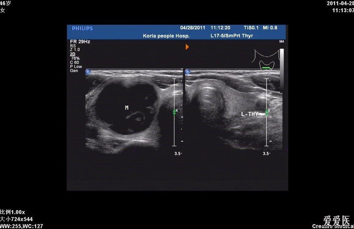 甲狀腺腺瘤囊性變合併囊內出血 - 超聲醫學討論版 - 愛愛醫醫學論壇 -