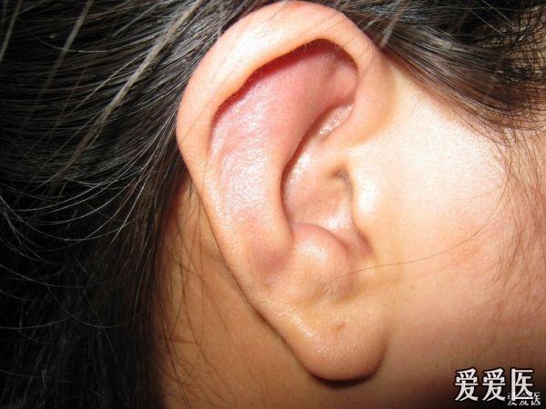 风湿性耳软骨膜炎 鲜花奉上