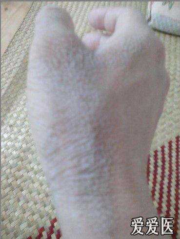 看图诊病————水源性角化病