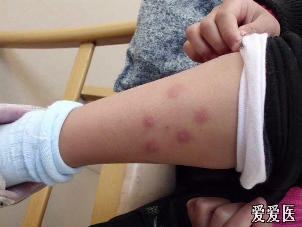 楼主肾病解惑2011-08-31 22:18:37荨麻疹  虫咬皮炎