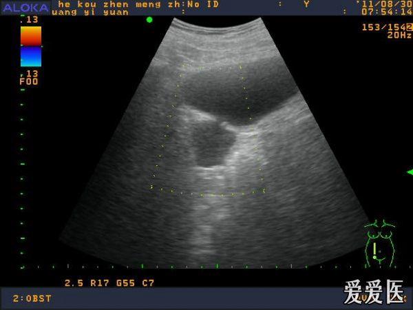 膀胱憩室?