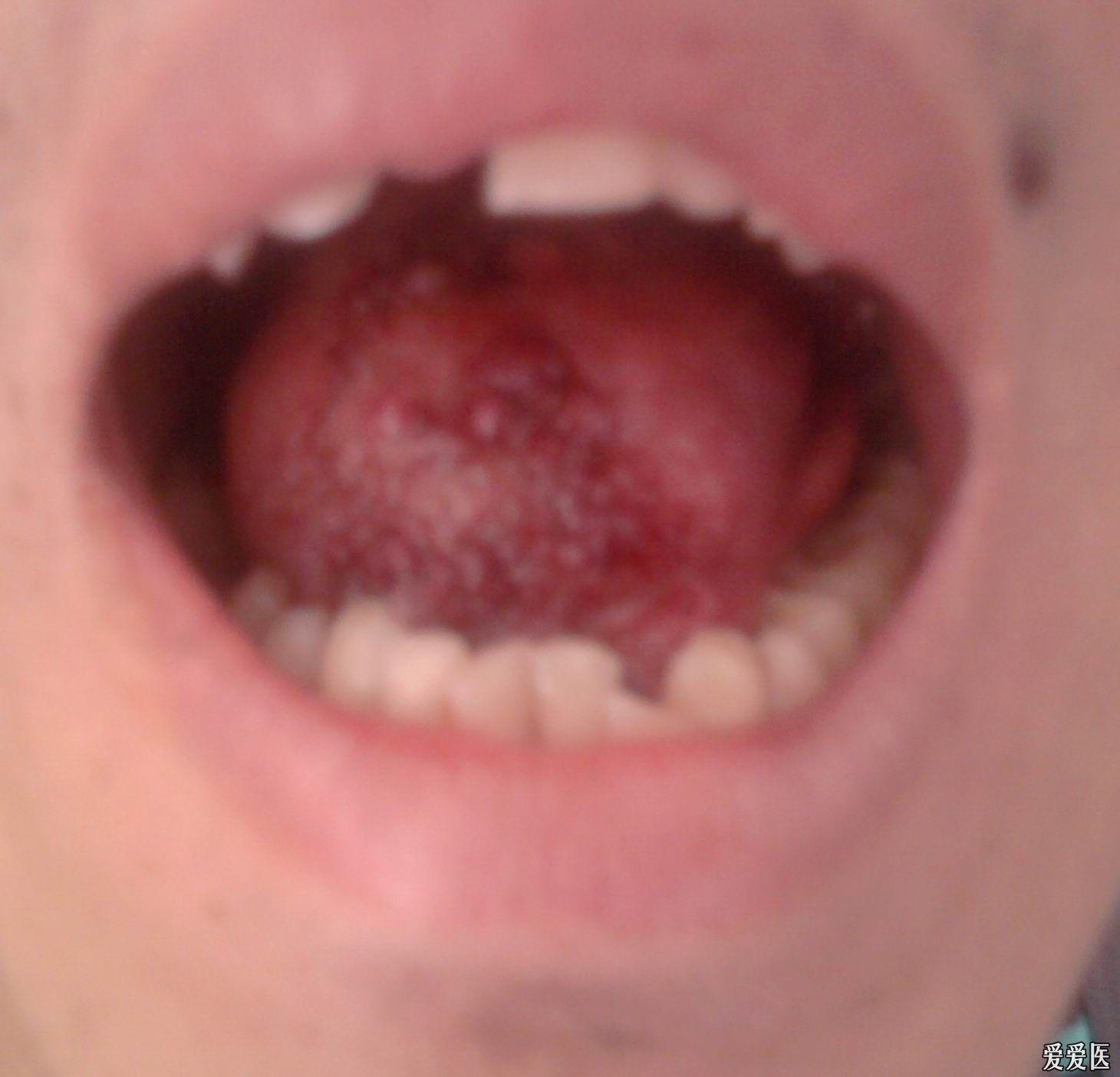 舌头上起个黑血泡图片图片