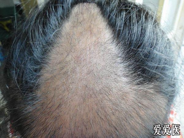 典型图片欣赏……头癣(黑点癣)