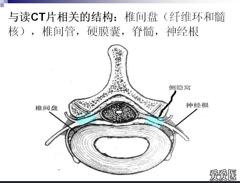 正常腰椎ct图解剖图片