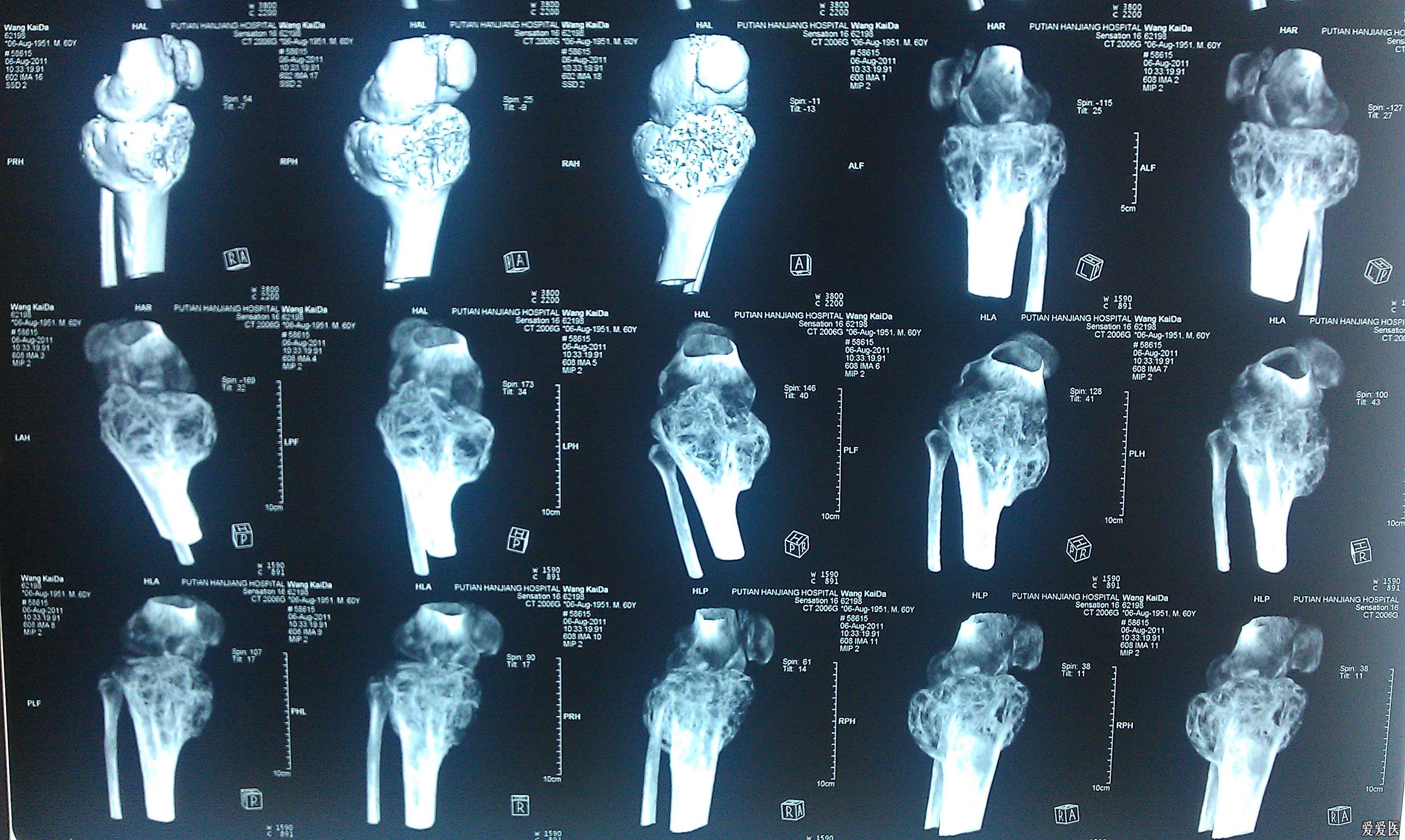 左胫骨平台骨巨细胞瘤一例