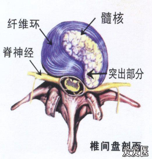 腰椎間盤突出骶管治療有效嗎!用的是什麼藥物?