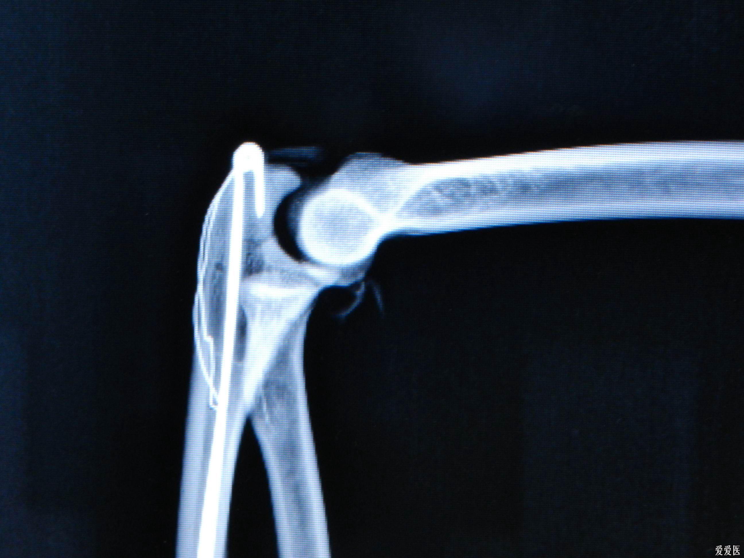 路过必看:新型专利,带孔钩的克氏针张力带治疗尺骨鹰嘴骨折