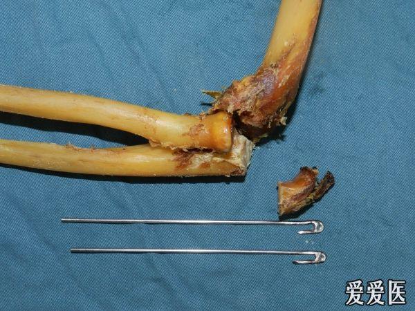 路過必看:新型專利,帶孔鉤的克氏針張力帶治療尺骨鷹嘴骨折