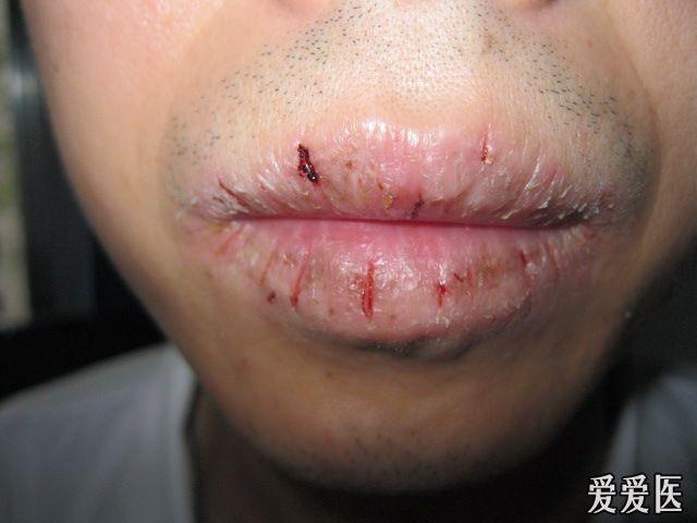 复发性唇炎