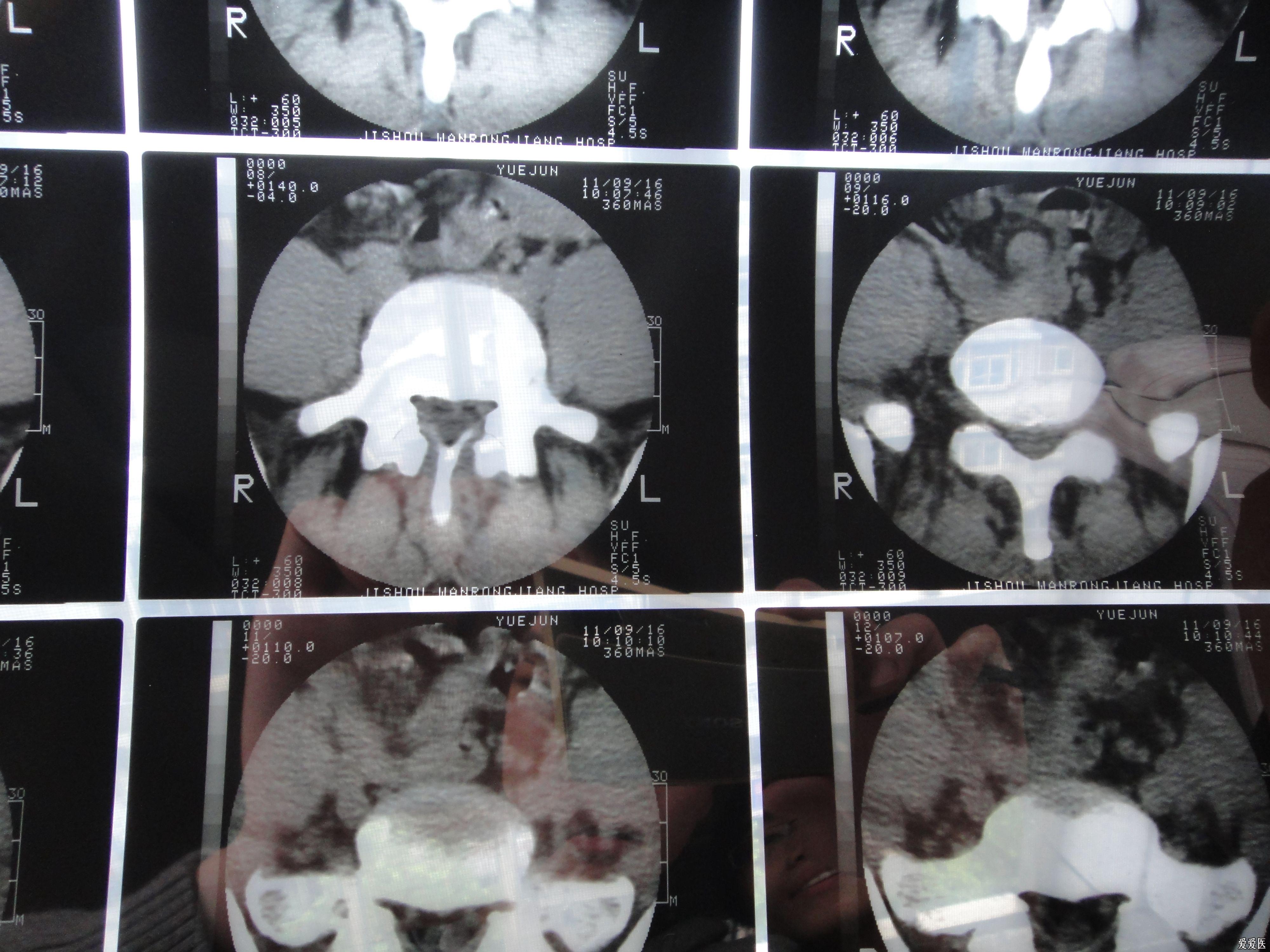 本人的腰椎ct--腰椎間盤突出
