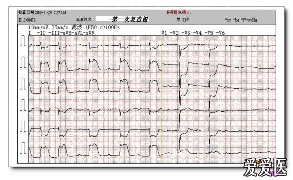 山羊老师课程常见心电图诊断知识讲座第二十五讲 急性心肌梗死