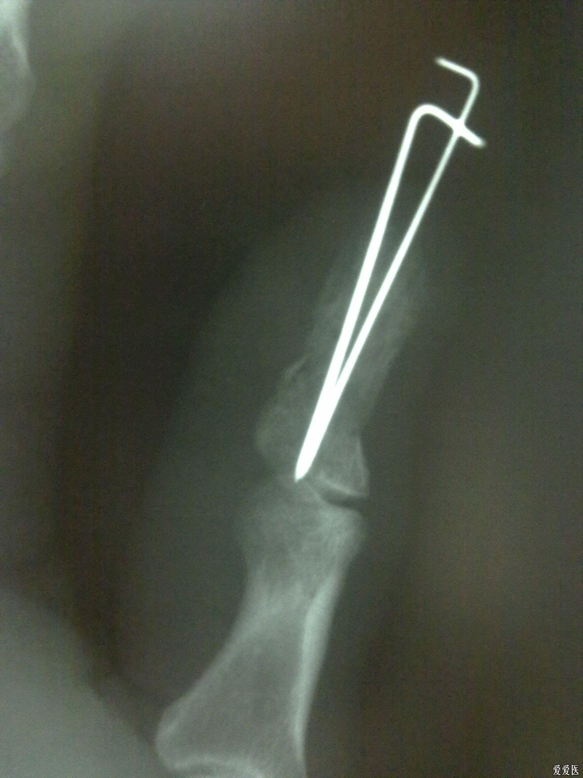 拇指指骨骨折闭合复位克氏针内固定