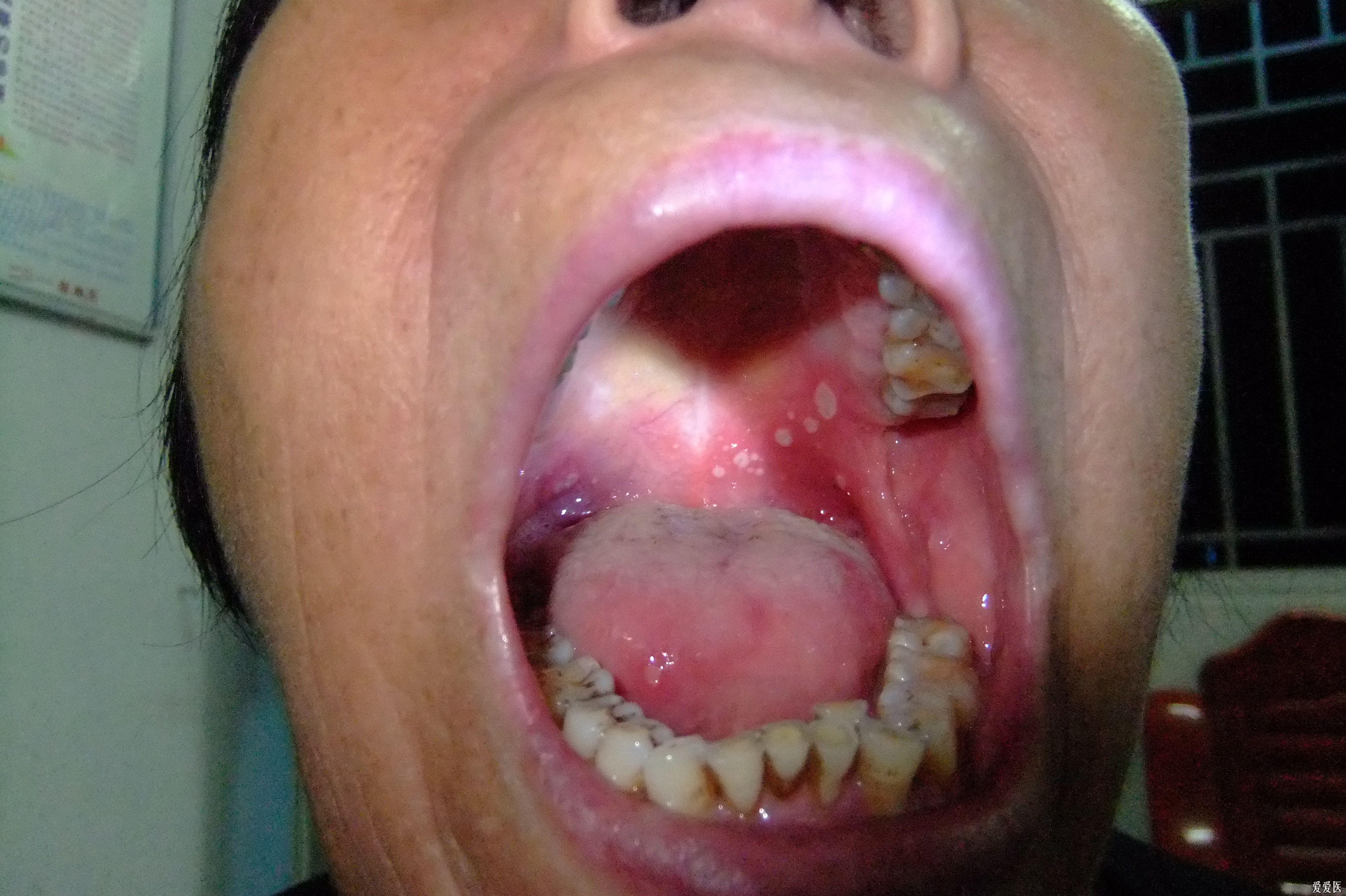 溃疡口腔的照片图片