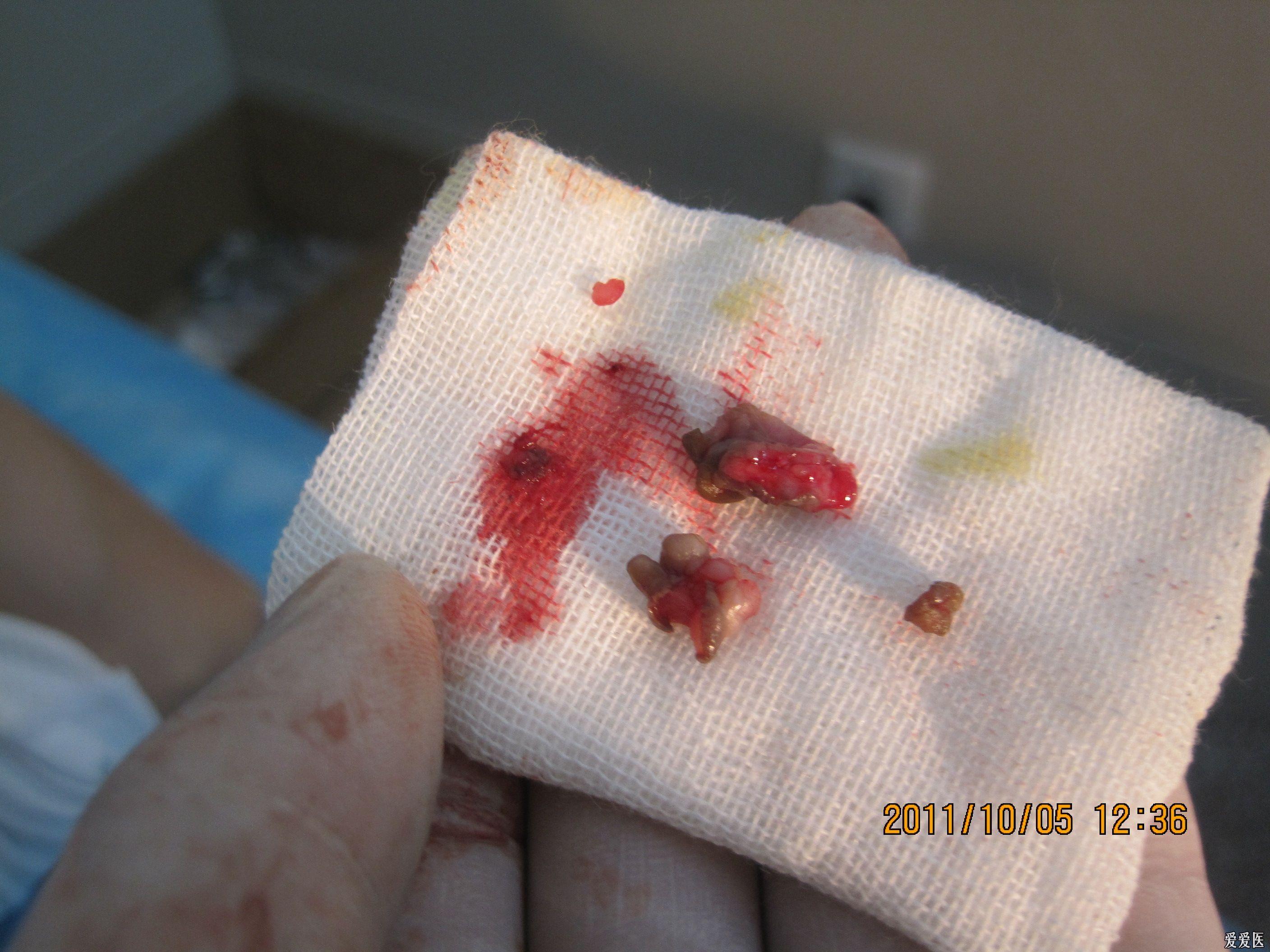 肛瘘术后伤口感染照片图片