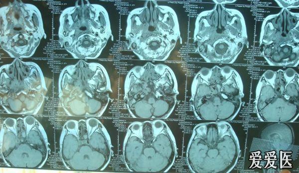 鼻咽癌 - 肿瘤医学专业讨论版 - 爱爱医医学论坛 - 爱爱医医学网