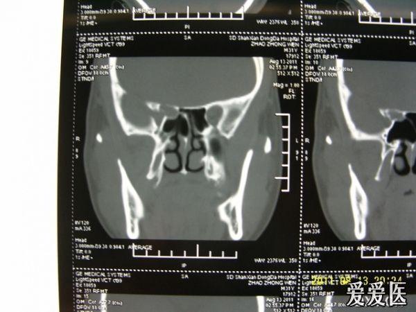 蝶窦囊肿CT图片