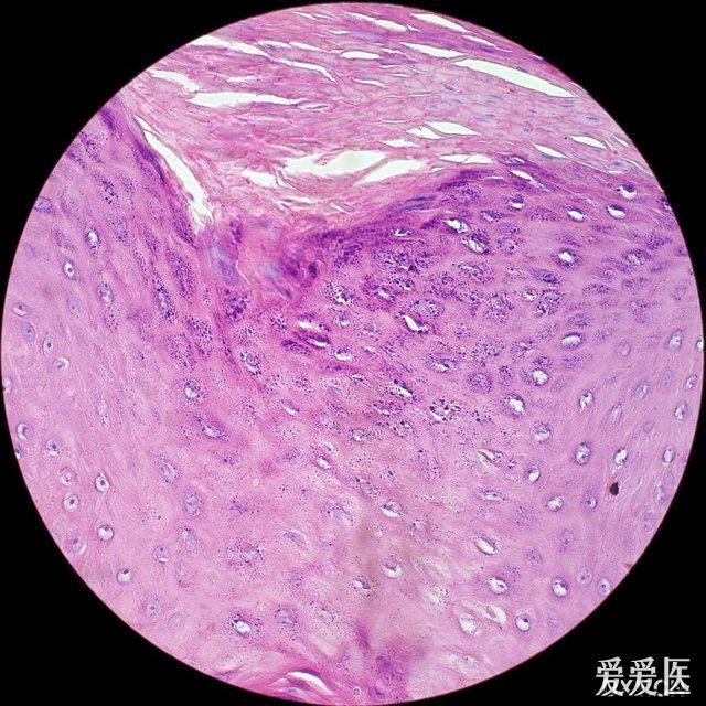 肉眼似皮炎,鏡下似尖銳溼疣和疣狀癌