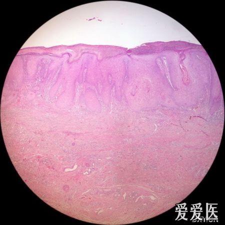 肉眼似皮炎,鏡下似尖銳溼疣和疣狀癌