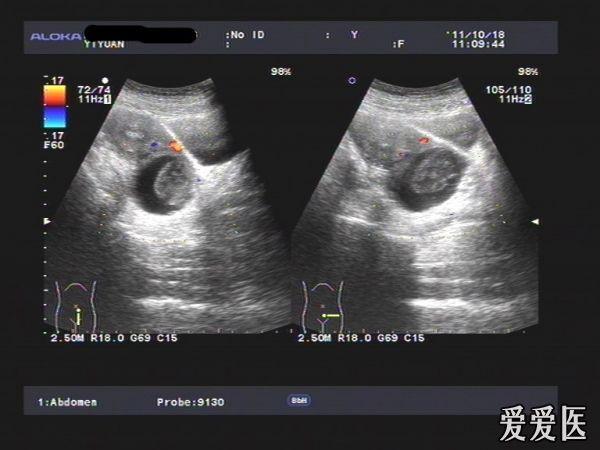 左卵巢囊实性包块,考虑畸胎瘤?