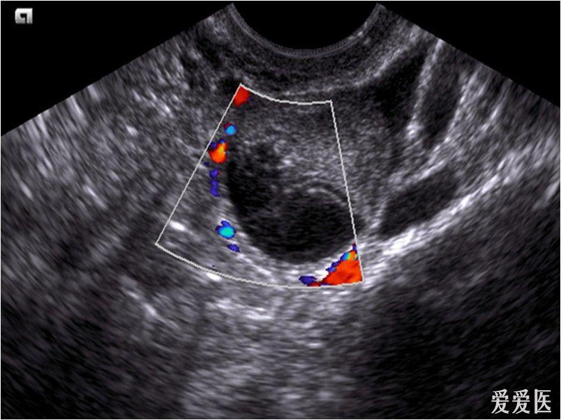 卵巢畸胎瘤超声图像图片