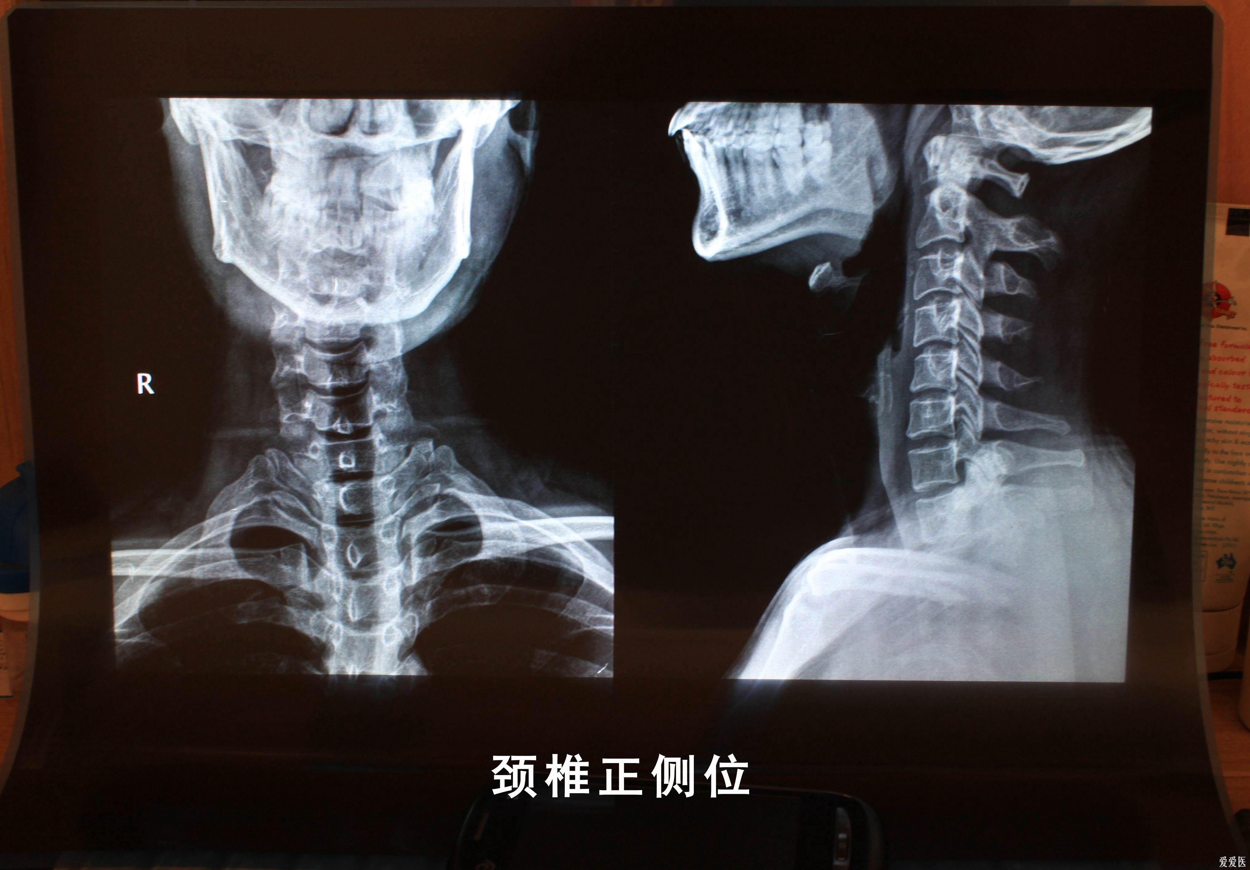 正常的颈椎x光图片图片