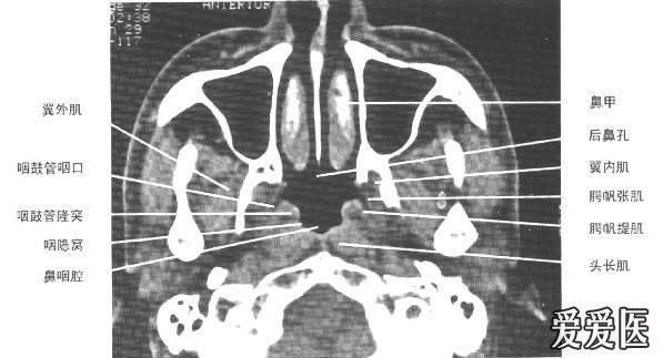 上颌窦解剖图CT图片