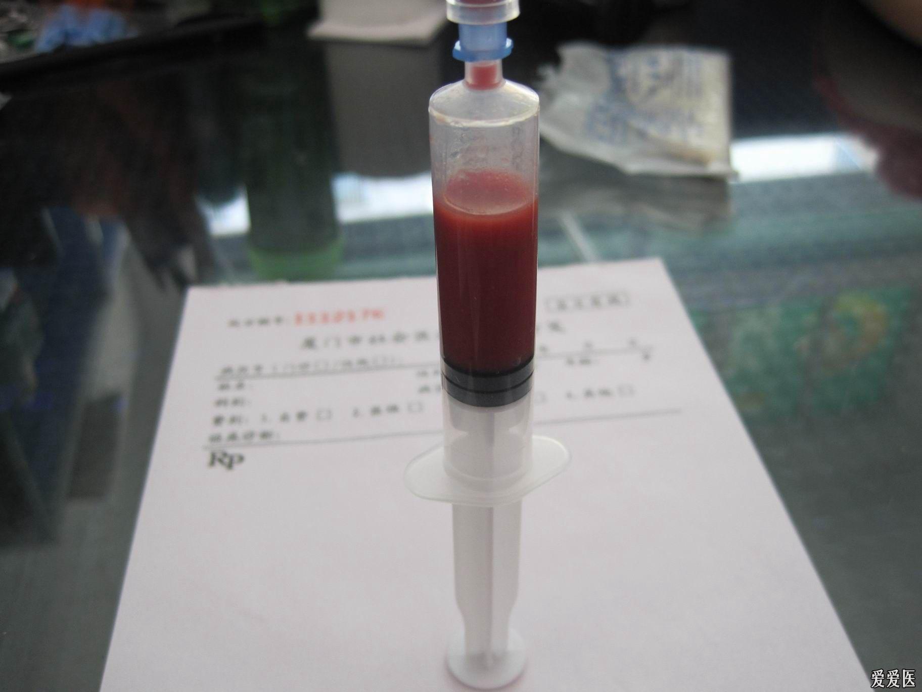 抽出液. 根据伤口脓液颜色诊断细菌感染