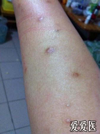 求助,过敏还是真菌感染,有图.