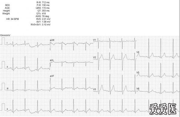 看图学心电01左右手反接与镜像右位心
