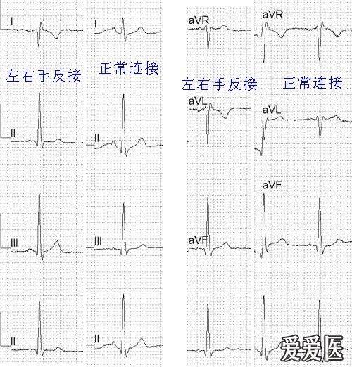 看图学心电01左右手反接与镜像右位心