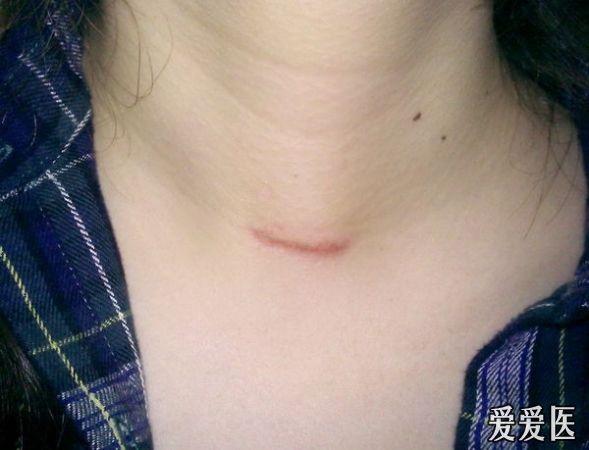 谈谈小切口甲状腺手术和甲状腺手术切口的愈合