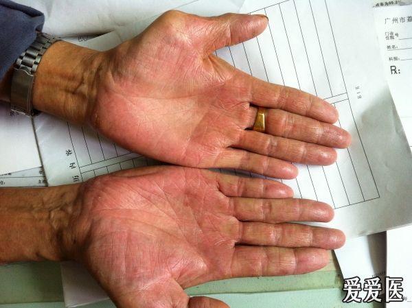手部皮损治疗后续(手湿疹:镍过敏)