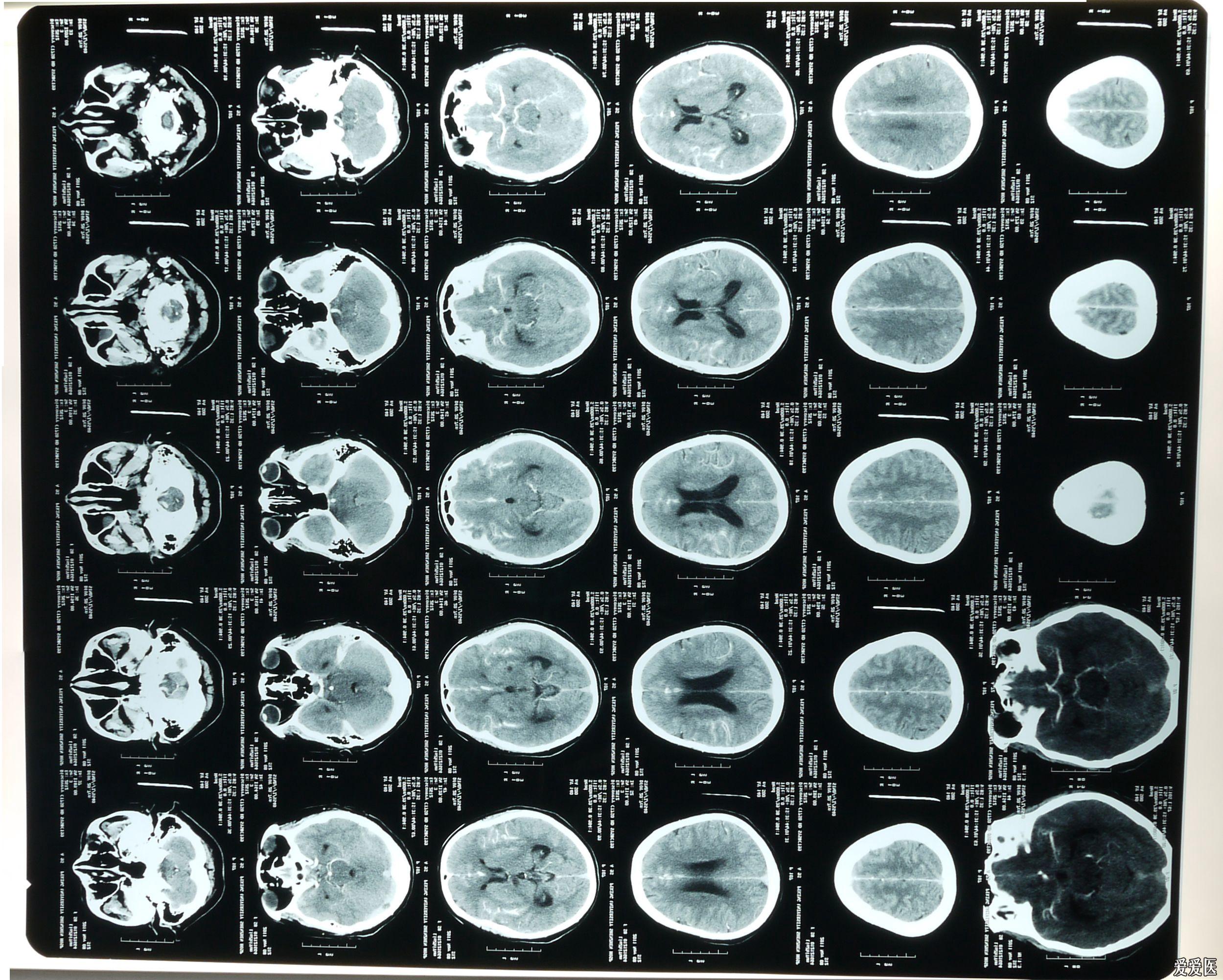药物治疗上以降颅内压 止血 抗脑血管痉挛 护胃 抗炎  促进脑细胞代谢