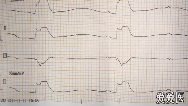 和常规不一样的死亡心电图,怎么下诊断?